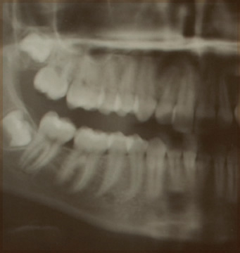 Digital Dental X-rays